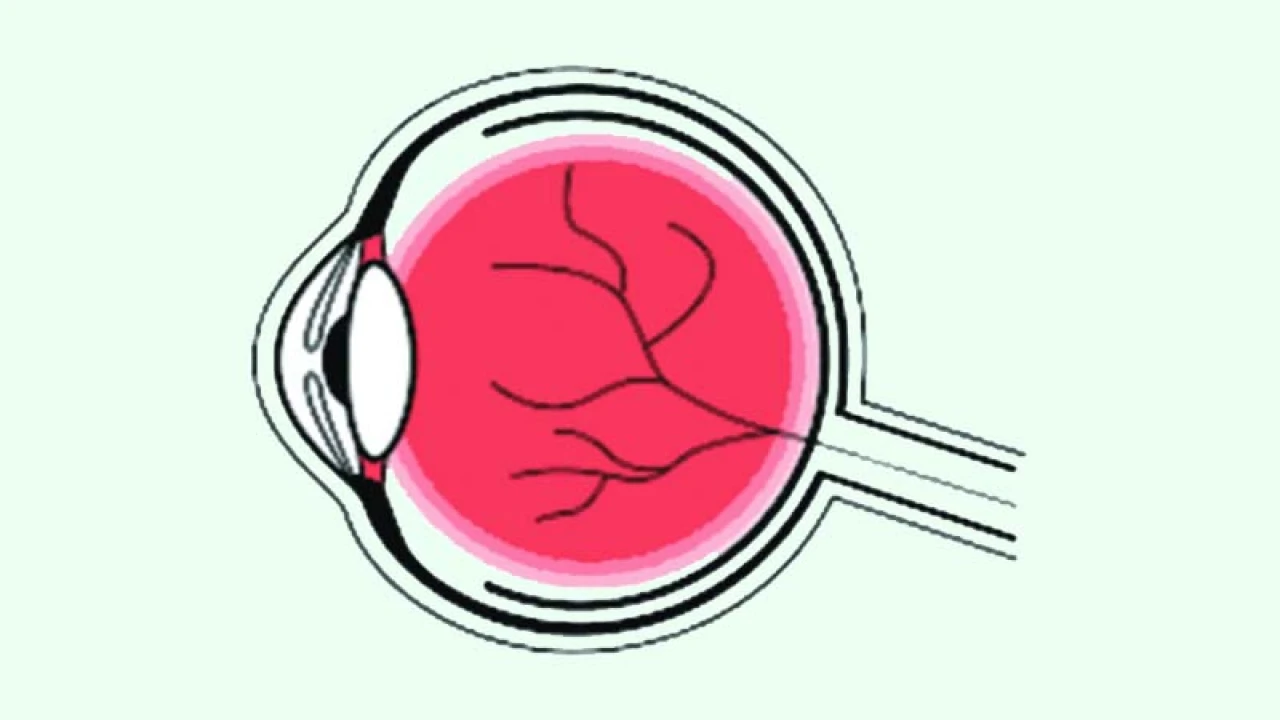 ইউভাইটিস রোগের আধুনিক চিকিৎসা