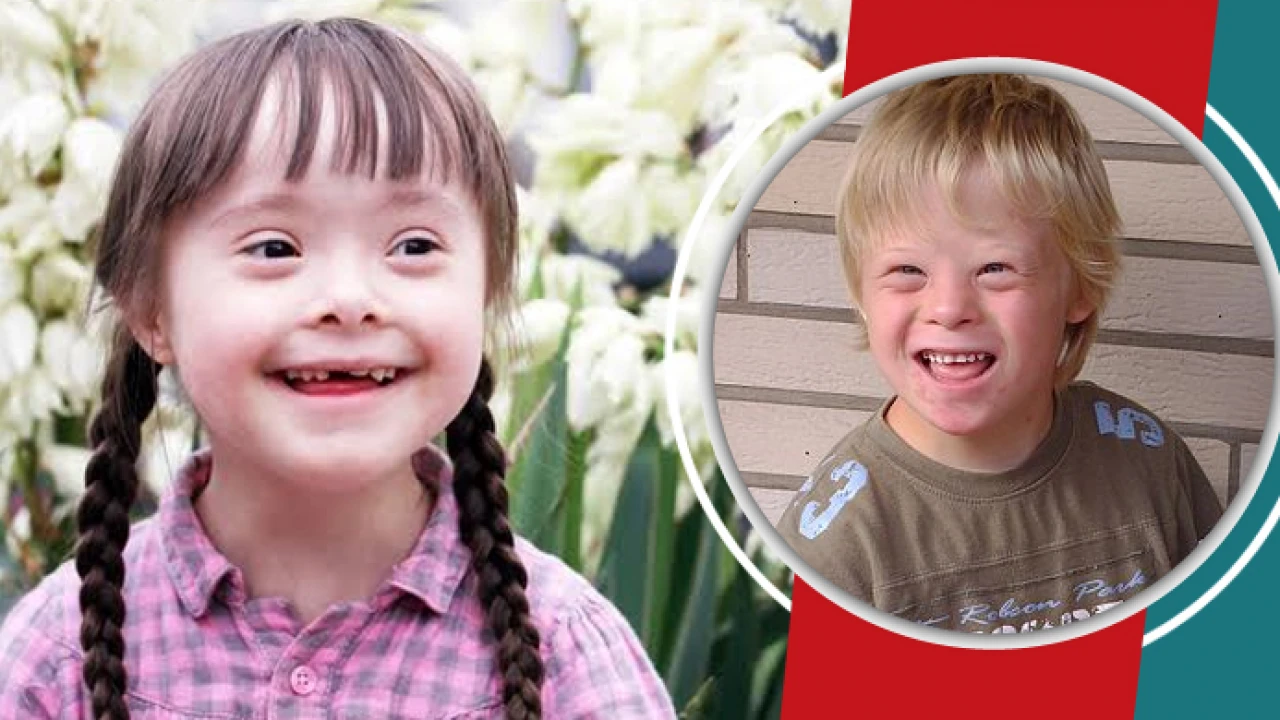 শিশুর ডাউন সিনড্রোম রোগের লক্ষণ ও চিকিৎসা