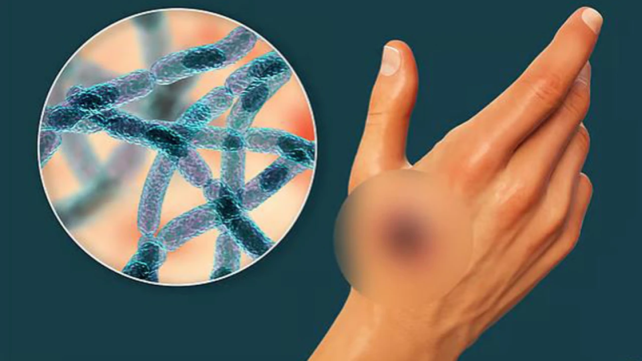 রংপুরে আরও ৩ জনের শরীরে অ্যানথ্রাক্স শনাক্ত