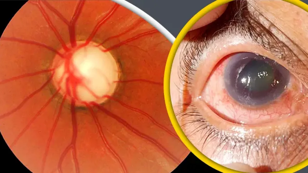গ্লুকোমা নামক মারাত্মক রোগটি প্রতিরোধ করবে যেভাবে