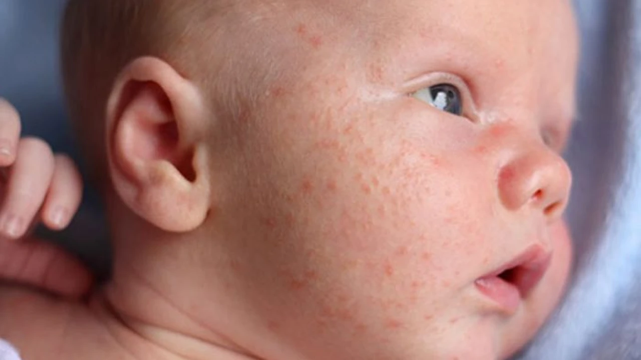 শিশুর ত্বকে অ্যালার্জি হতে পারে আর্টিকারিয়া বা আমবাত রোগ