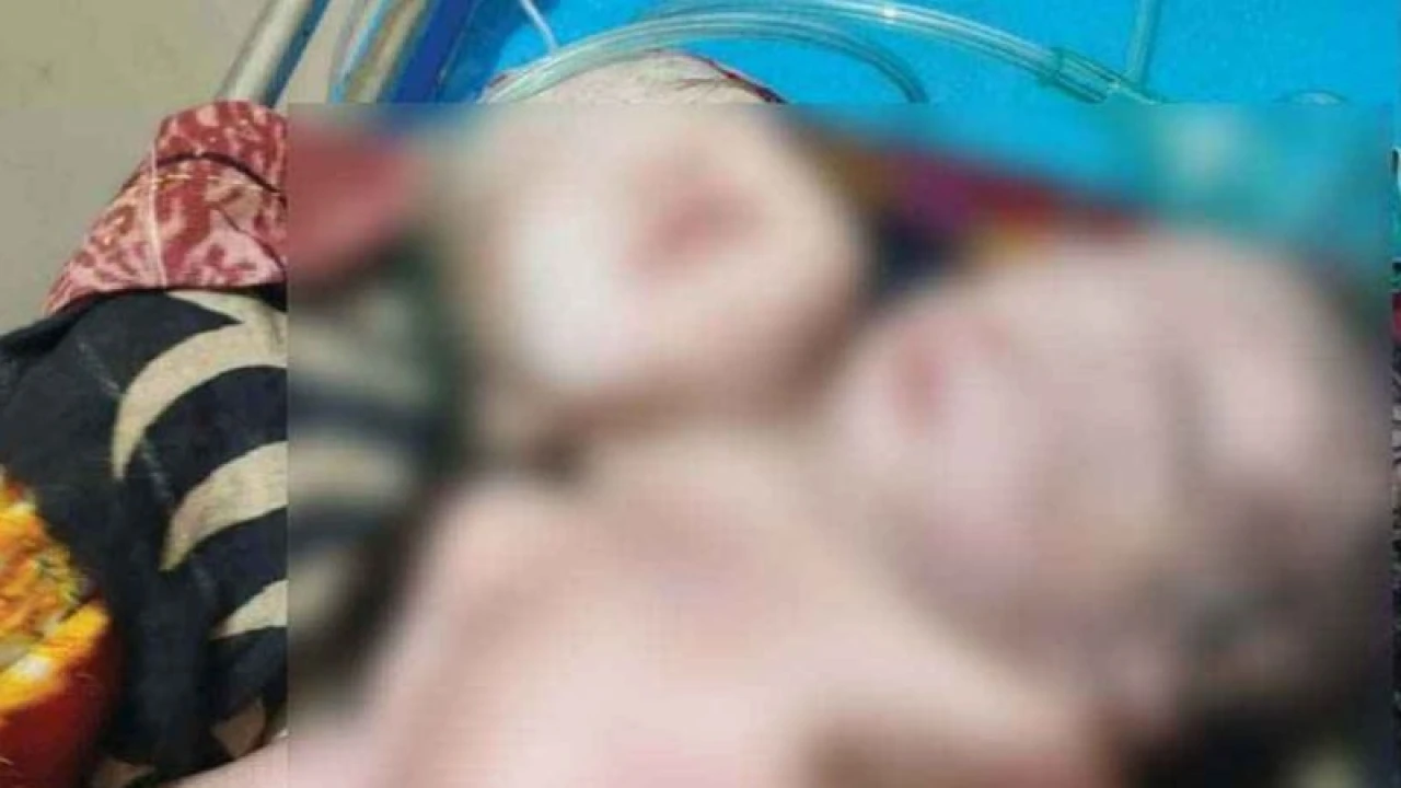 পিরোজপুরে দুই মাথাওয়ালা শিশুর জন্ম