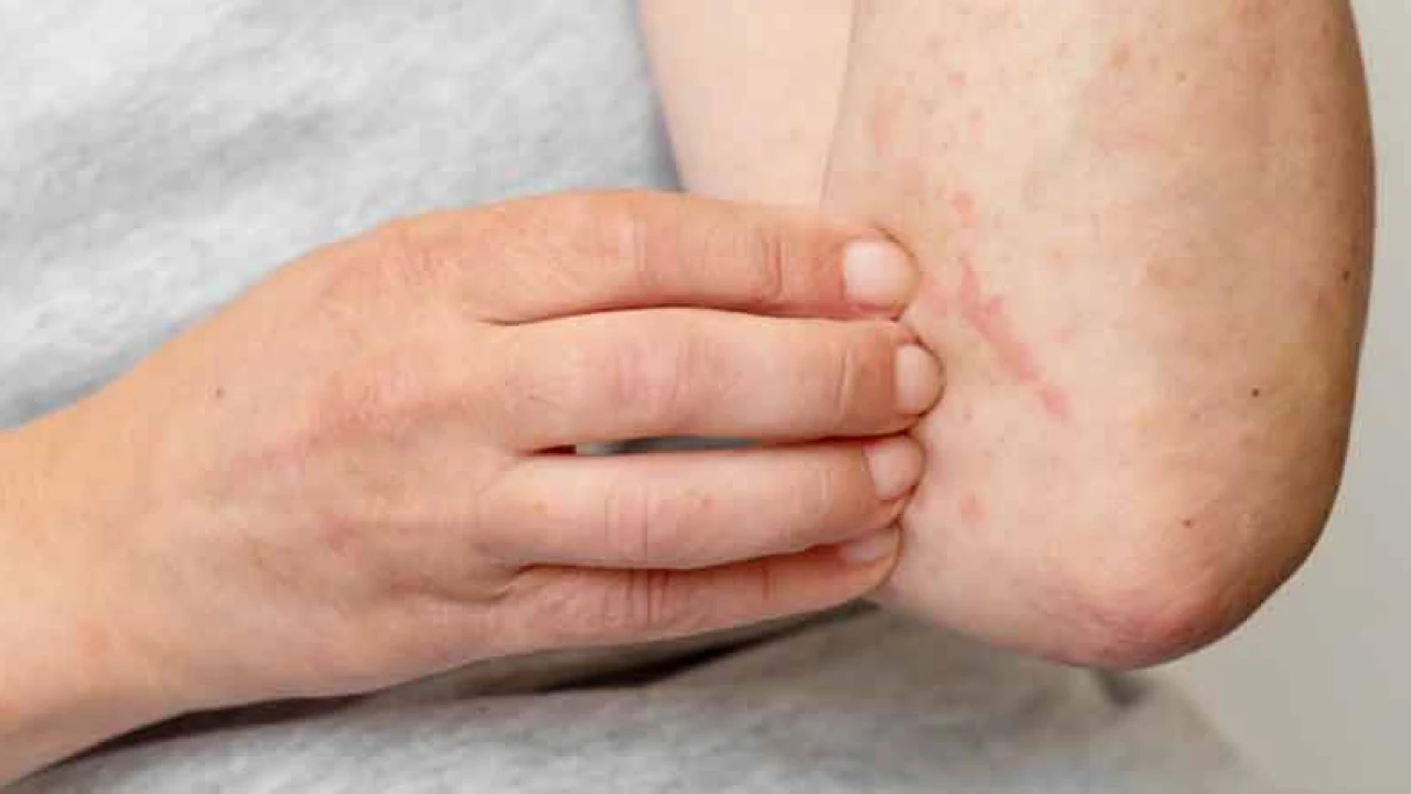 অ্যালার্জি থেকে দূরে থাকবেন যেভাবে